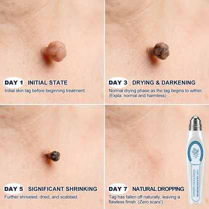 Official Brand Store |✅🧑🏻‍⚕️Anyumm™ 7-Day Tag & Spot Eraser(Zero Pain, Zero Scars Rollerball)